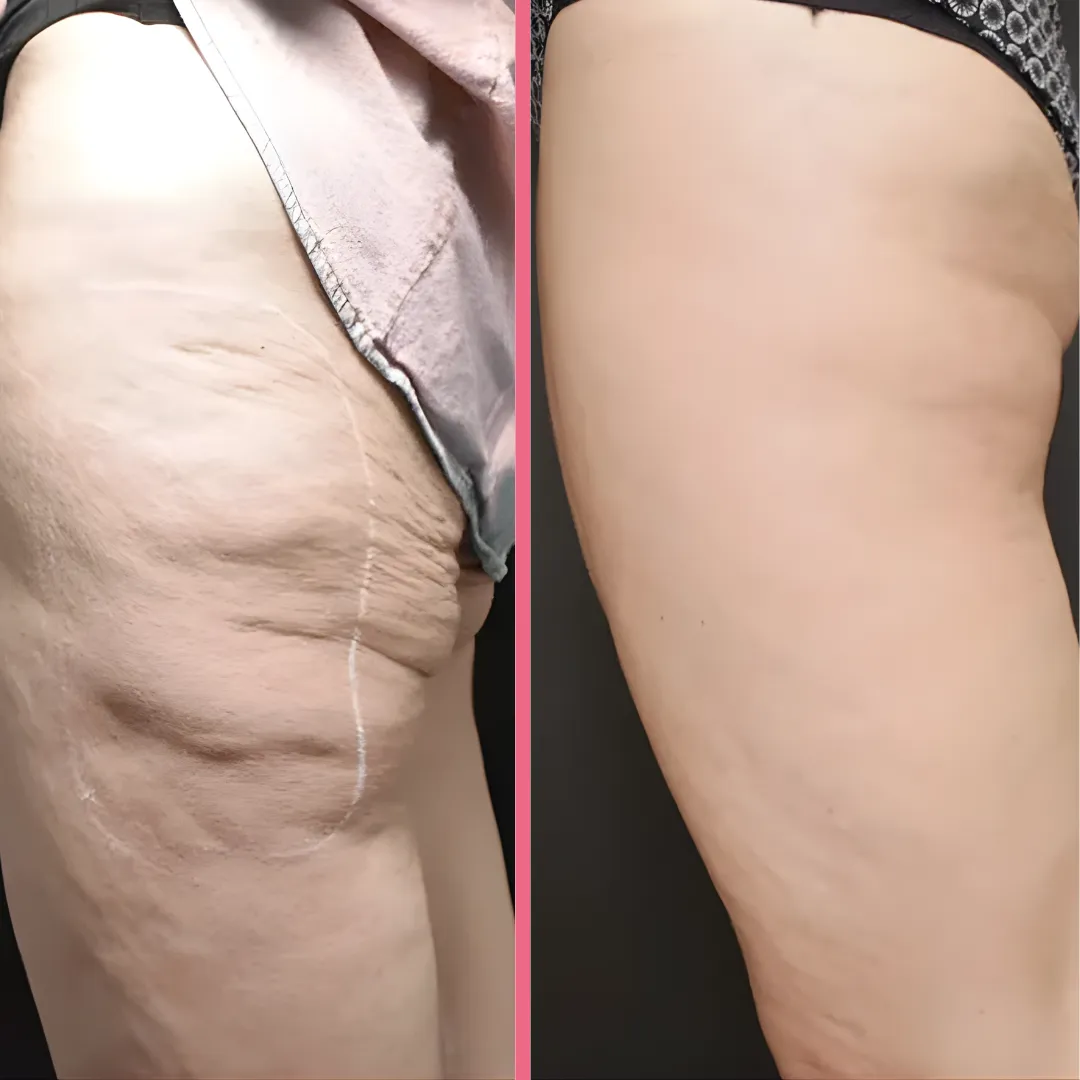 SculptPro™ 3-in-1 Skin Firming & Cellulite Massager - Image 11